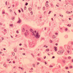 Person with measles visited Boston, health officials warn