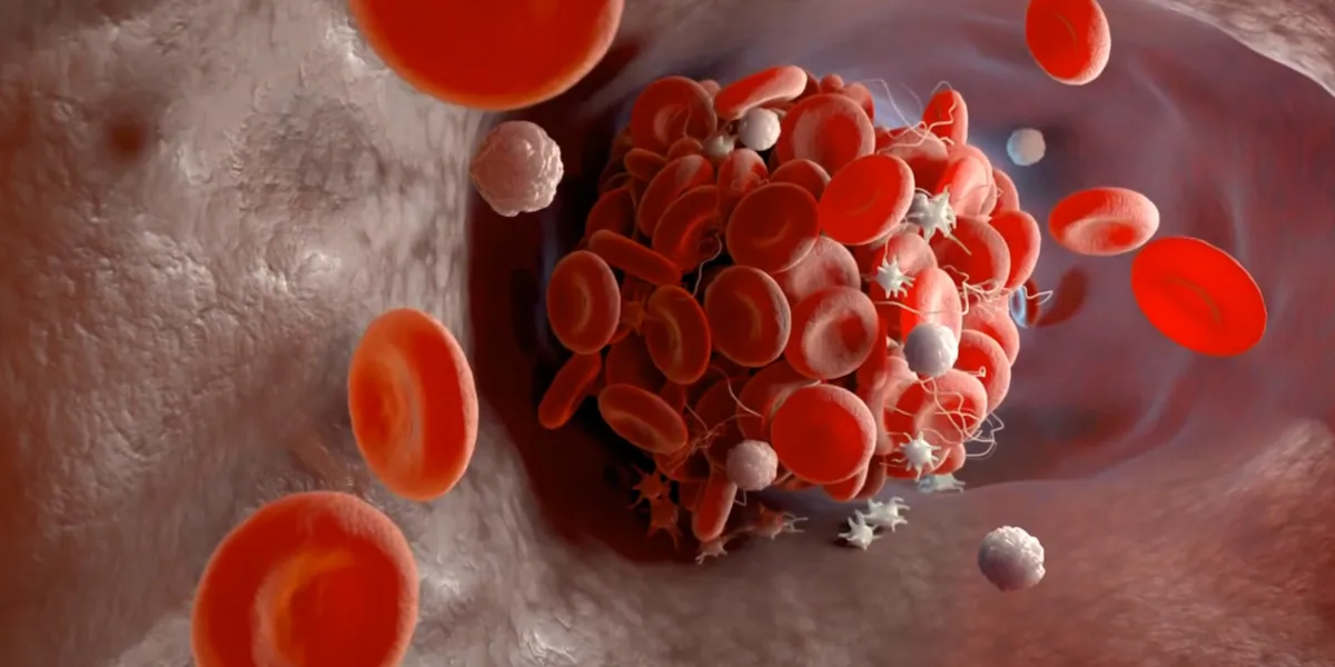 Travel could heighten your chances of a blood clot, experts say