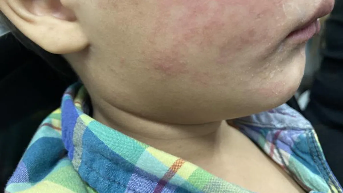 Oregon Health Authority confirms first measles case of 2025