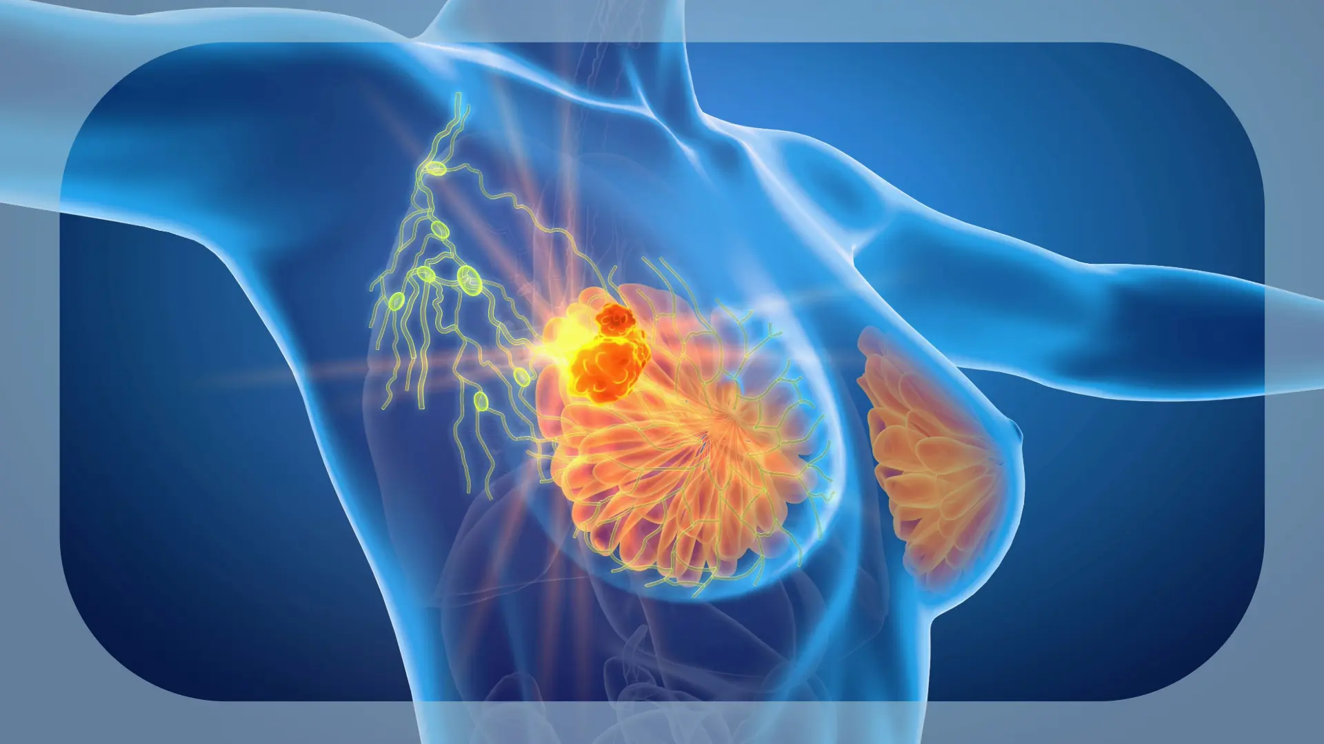 Health Canada Approves Adjuvant Ribociclib for HR+/HER2– Early Breast Cancer