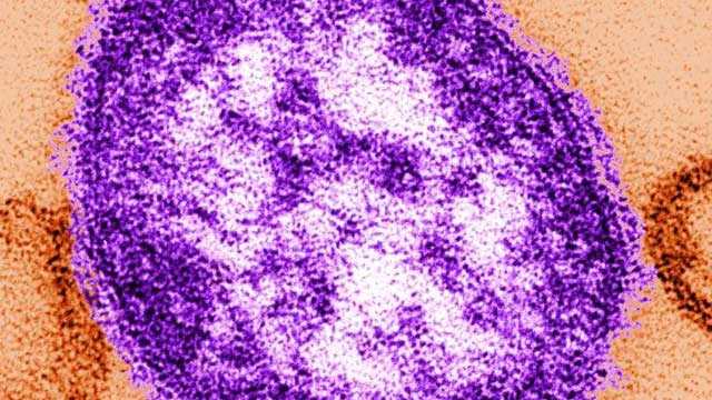 West Sacramento resident becomes 13th California measles case this year; did not travel abroad