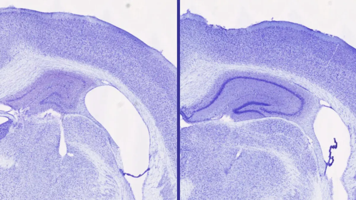 Alzheimer's hope: Sleep aid blocks up to 40% more harmful tau deposits