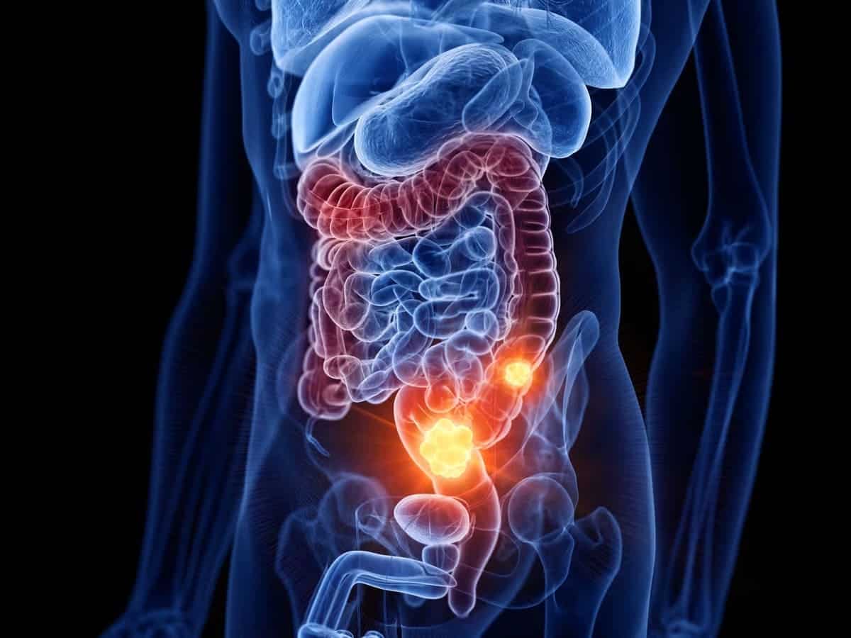 Colon cancer: lifestyle changes that could make all the difference, according to science - Futura-Sciences