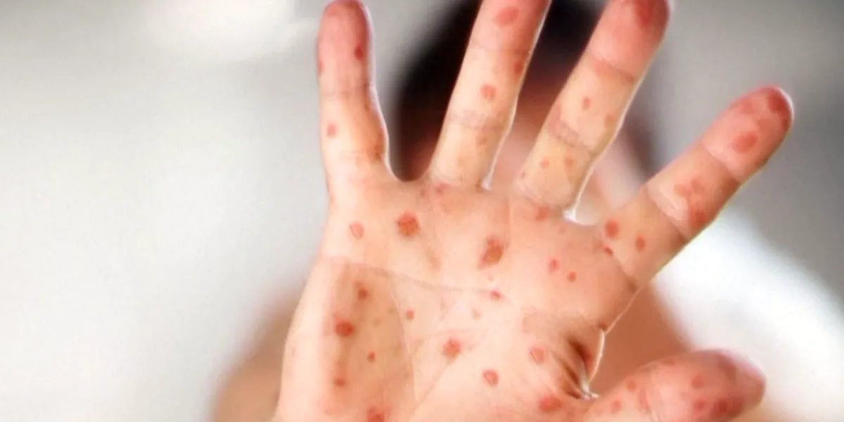 Kansas health officials share details of measles exposure at Wichita medical center