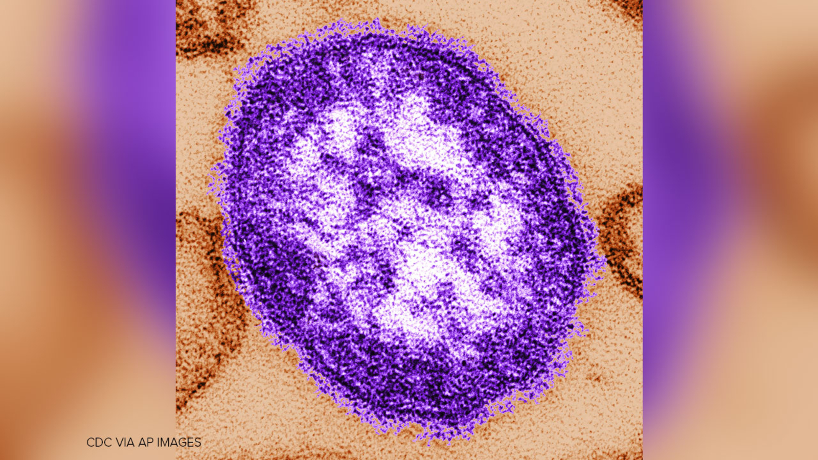 Measles case confirmed in traveler who passed through LAX, county health officials say