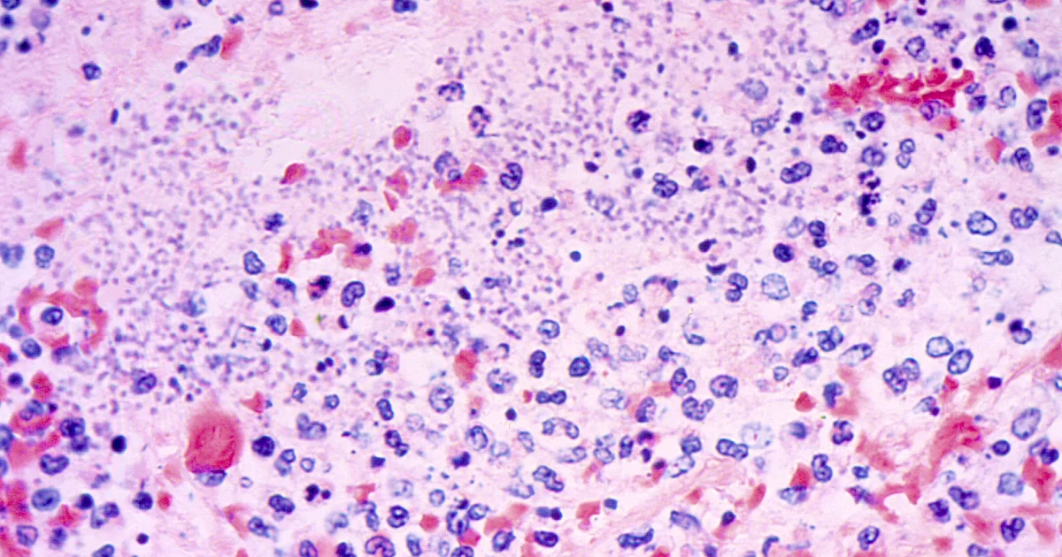 Plague kills Arizona resident, marking first recorded death since 2007, health officials say