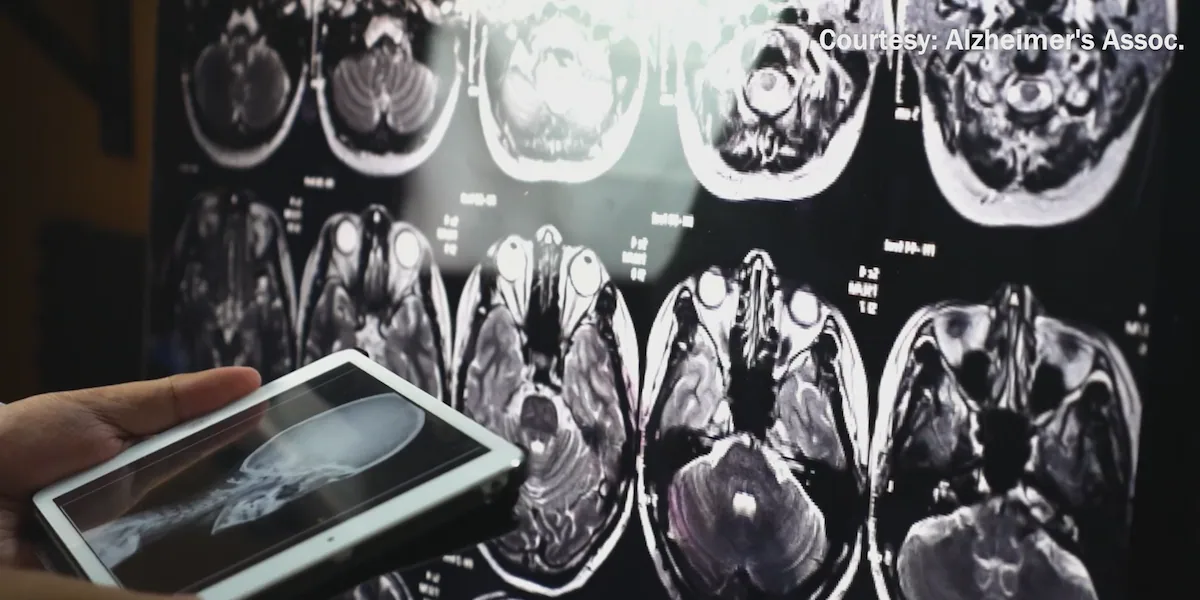 Study: Small lifestyle adjustments can significantly impact brain health