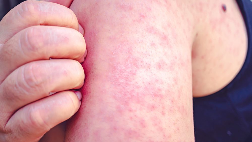 State health officials warn of potential measles exposure
