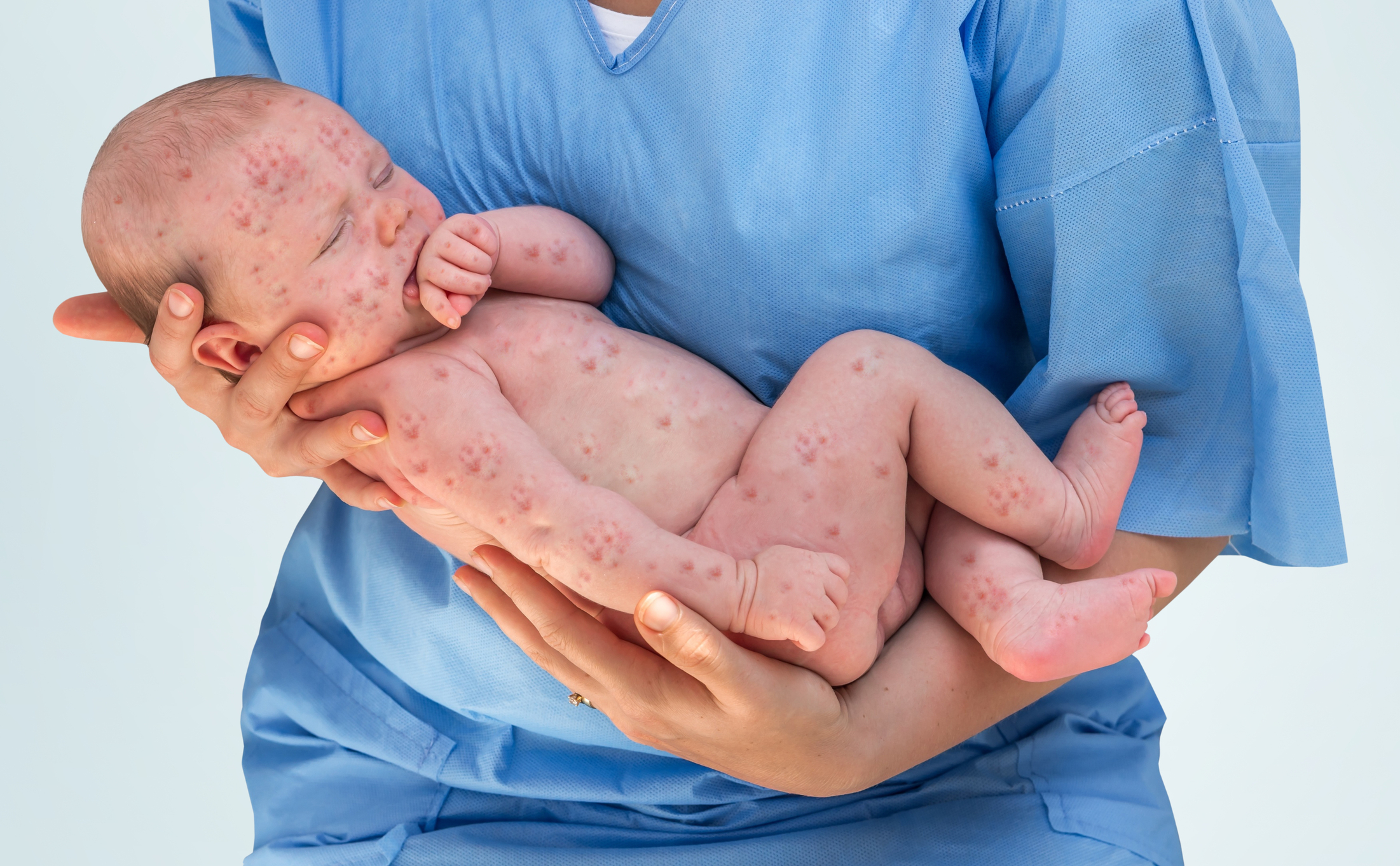 Summer travel ‘will increase the spread of measles,’ expert says