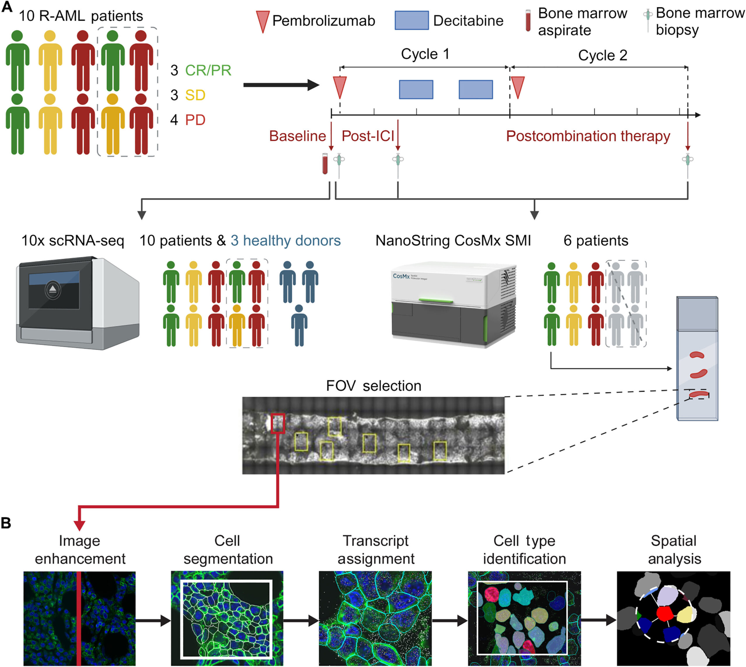 Immunotherapy alters bone marrow environment in acute myeloid leukemia patients