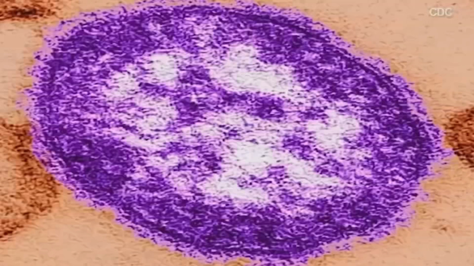 Tulare County health officials confirm 2 cases of measles