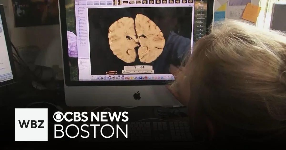 BU research has found high school sports can lead to development of CTE