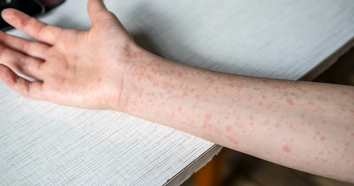 Health officials confirm two more measles cases in Kent County, Michigan