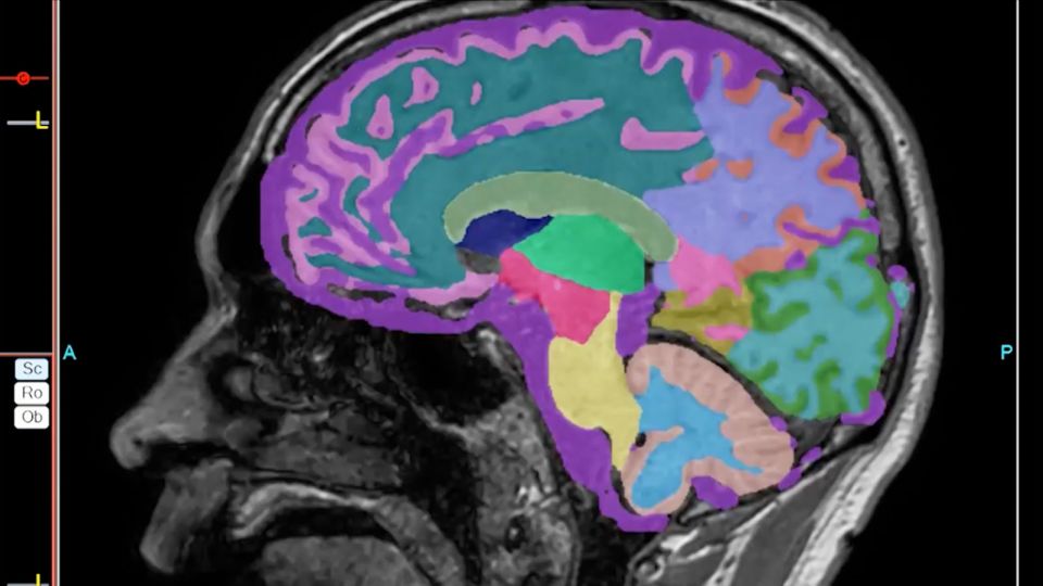 FIRST ON CNN: Dramatic lifestyle changes can fight early-stage Alzheimer’s, study says. Here’s how
