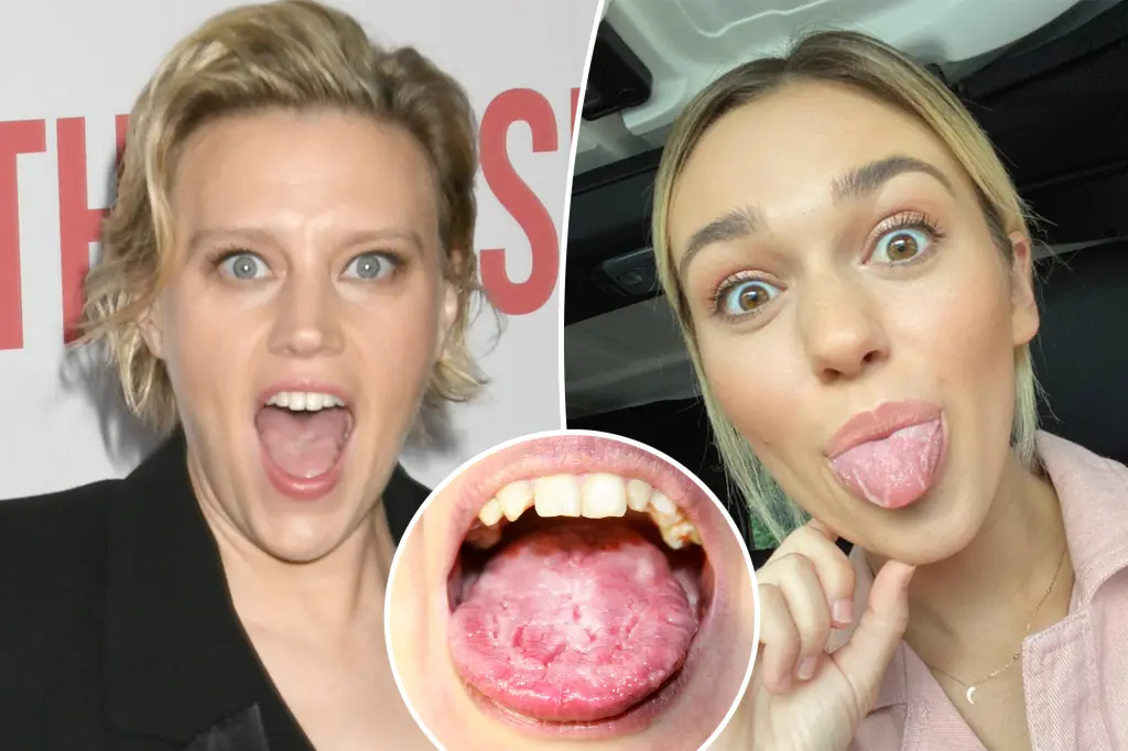 What is 'geographic tongue'? All about 'SNL' star Kate McKinnon's...